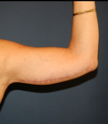 Feel Beautiful - Arm Reduction 201 - After Photo